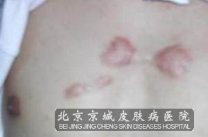 怎样预防瘢痕疙瘩