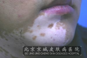北京治疗白癜风较好的医院
