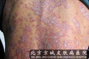 银屑病能 吗