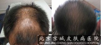 脱发的治疗