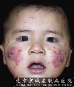 介绍痤疮暗疮治疗方法