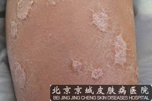 寻常型银屑病的症状