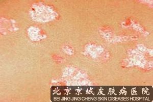 得了银屑病怎么治疗较好