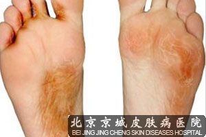 手足癣发生如何治疗