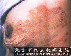 儿童体癣如何治疗