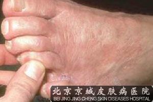 介绍足癣治疗方法