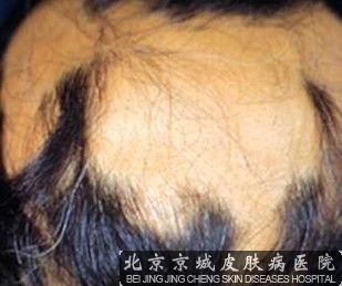 斑秃能 吗