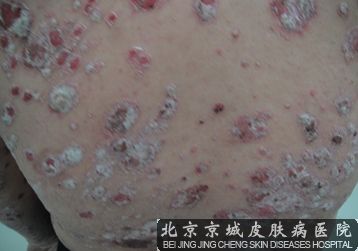 牛皮癣的较的治疗