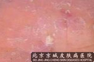 患手足癣能吗