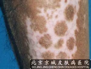 白癜风增强身体抵抗力的方法有哪些