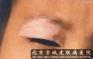 白癜风能吗