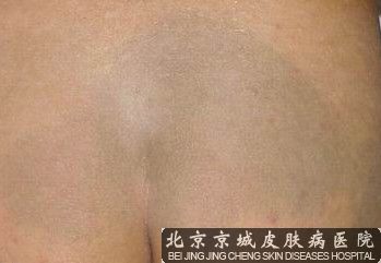 屁股胎记怎么去除