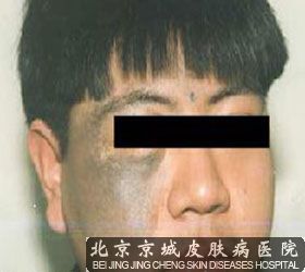 胎记的并发症都有什么