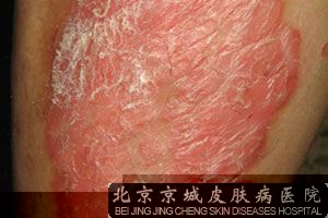 牛皮癣一直治不好怎么办