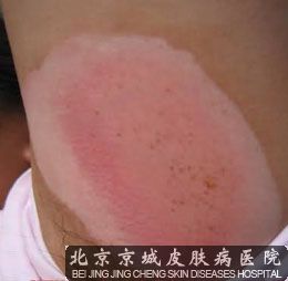 白癜风该如何治疗才较果呢