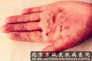 手上起水泡什么病