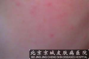 皮肤反复过敏是怎么回事