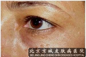 汗管瘤的治疗方法