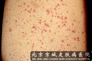 身上长红点怎么回事