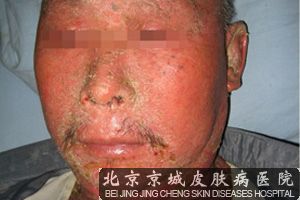银屑病该怎样治疗较好