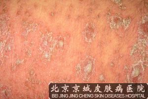 如何预防银屑病的复发呢