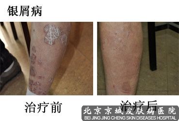 银屑病的治疗方法