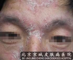 银屑病能吗