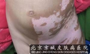 如何治疗白癜风