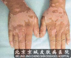 偏方治疗白癜风应该注意哪些