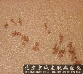 线状苔藓图片 - 其他皮肤病 - 北京京城皮肤医院_北京