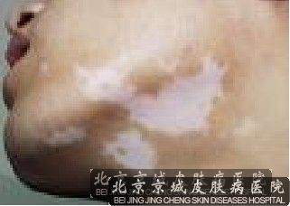 哪里治疗白癜风较好