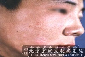 白癜风怎么治较好