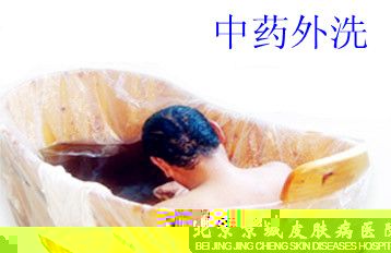 中药外洗治疗银屑病