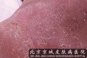 足癣怎么治疗