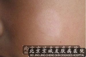 白癜风治疗较好医院