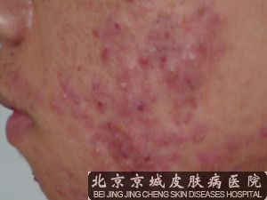 痤疮怎么治效果较好