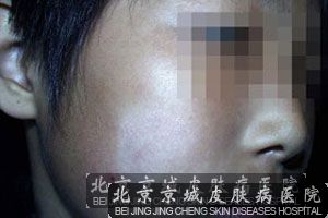 白癜风早期能吗