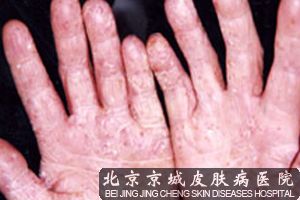 手癣是指手掌部的皮肤癣菌感染,表现为水庖,角化和鳞屑性斑片.