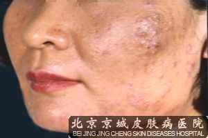 治疗青春痘较快的方法