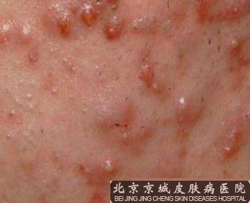 治疗痤疮较的方法