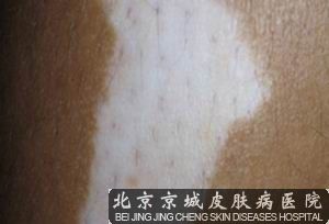 白癜风专业医院