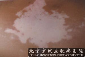 北京治疗白癜风较好医院