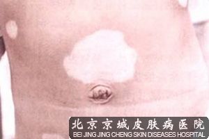 白癜风治疗较好医院