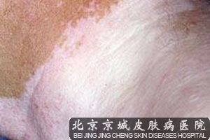 治疗白癜风专科医院