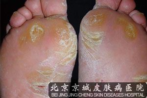 治脚气较的方法