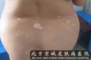 白癜风医院