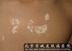 白癜风能 吗