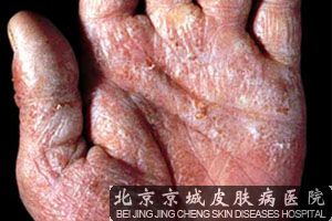 鹅掌风图片