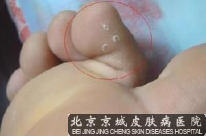 脚气图片是什么样的