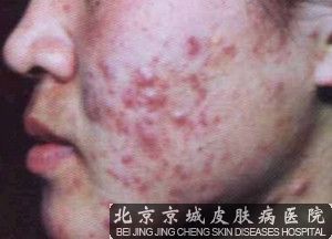 治疗痤疮较快的方法